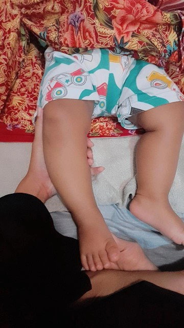 Kaki anak bengkok