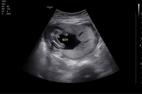 Usg 16w baby boy