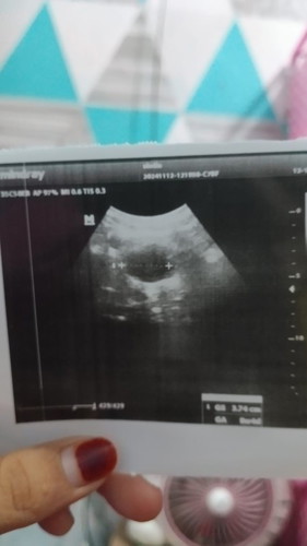 Bunda mau tanya usia kandungan 8 minggu tapi baru ada kantong, itu normal tidak yaa bun?
