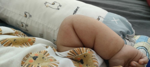 Ini biang keringet atau apa ya bun?