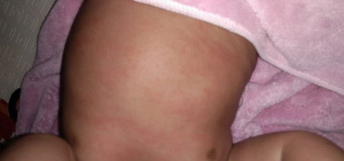 Ruam pada badan bayi