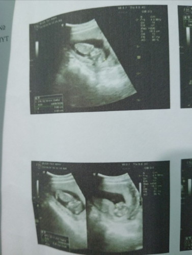 Mọi người ơi cho em hỏi e đc 15tuần mà con em đc 63gram vậy đủ tiêu chuẩn chưa mn. Cho em xin ý kiến