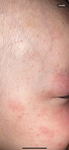 ผื่นแบบนี้เกิดจากอะไรคะ