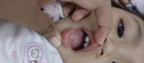 Gigi jarak usia 1 thn