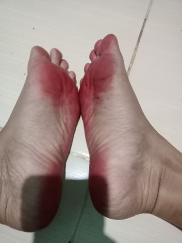 Bunda" disini ada yg tau gk ya ini kaki ku kok warna merah sprti darah kayak gini yaa, hamil 10w5d..