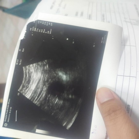 pengalaman tgk scan rahim