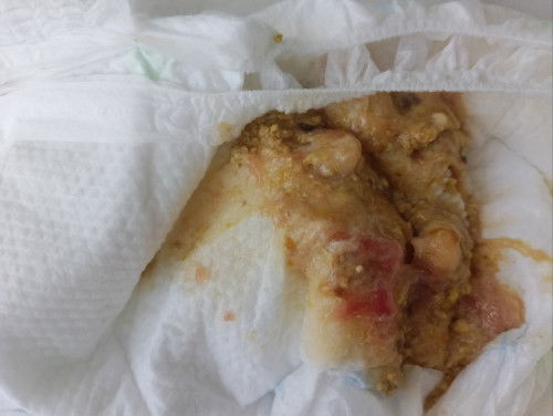 Bakit po kaya ganito poop ng anak ko..