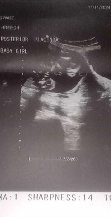 may nagkakamali po ba ng ultrasound ano po sa tingin niyo boy or girl ?