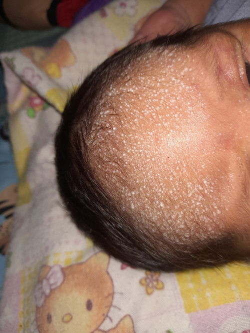 Bruntusan pada bayi 10 hari