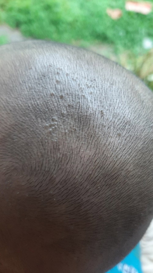 Bayi gundul kulit kepala seperti bruntus