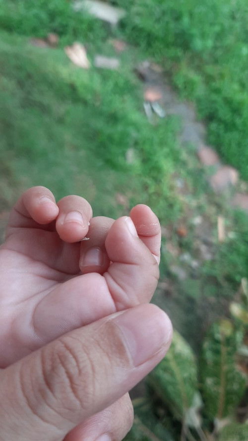 Kulit jari bayi mengelupas