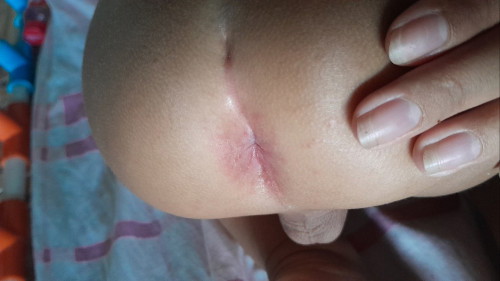 น้องถ่ายบ่อยถ่ายนิดเดียวมีตัวร้อนร่วมด้วย