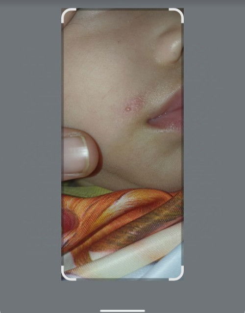 BINTIK PUTIH SEPERTI JERAWAT