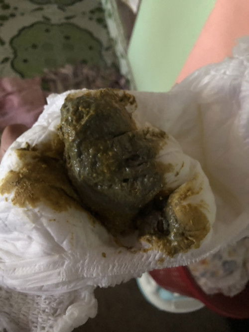 สีอึน้องแบบนี้ปกติมั้ย