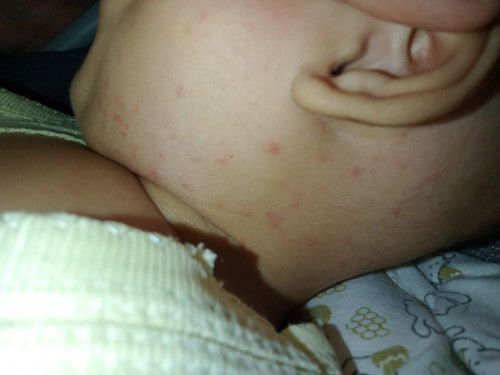 Ruam merah leher dan punggung bayi