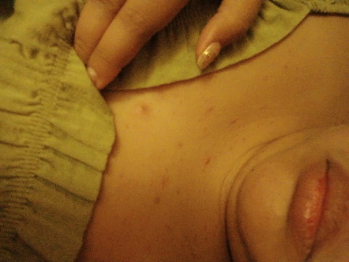 Skin Rashes/acne