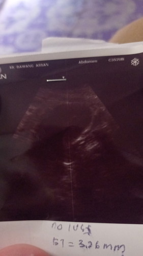 Saya nak mommy sapa ada macam saya scan 7minggu nampak kantung saja dr suruh repeat scan 2week lagi.