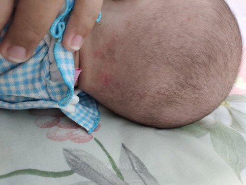 Mau tanya nih Bun..blkang kepala bayi muncul merah" spti itu..kira" knpa ya? Trs dipakein obat ap y