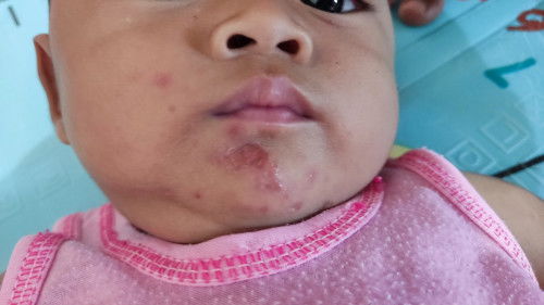 Gatal berair pada bayi