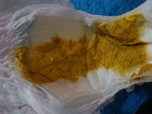 Poop cair pada bayi 5 bulan