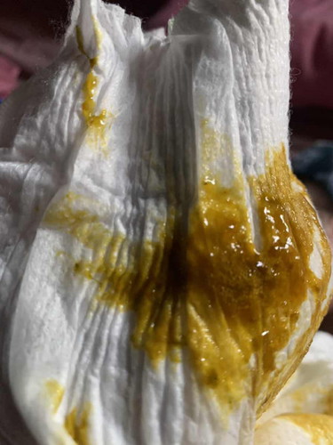 แบบนี้คือมูกเลือดไหมคะ