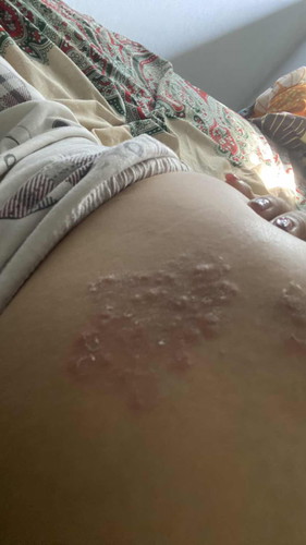 Salep dan obat kulit yg ampuh