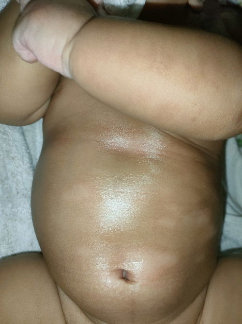 Perut bayi ada bercak putih