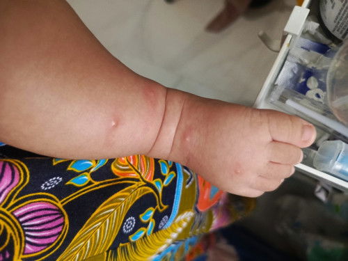 Ruam merah setelah 2hr ada bintik bentol dan berair di tengah knpa ya mom? Baby ku usia 2,5 bulan