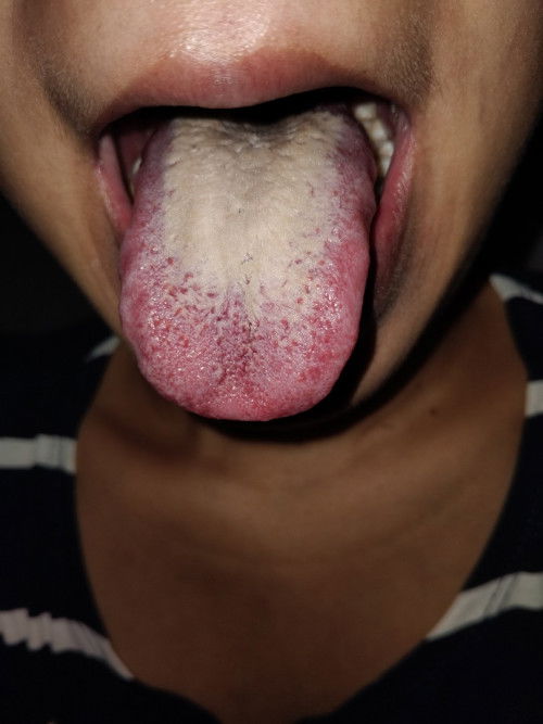 warna lidah jadi putih kebal