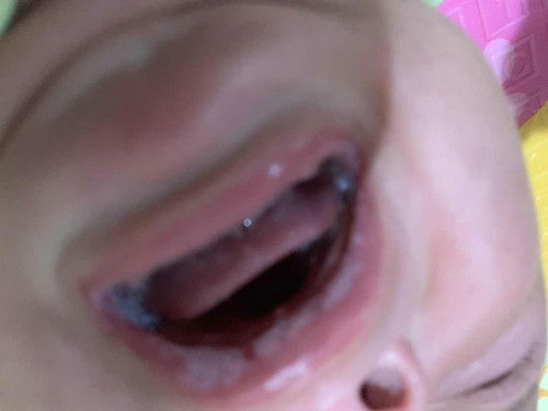 Cara ngilangin sariawan pada bayi usia 4bulan