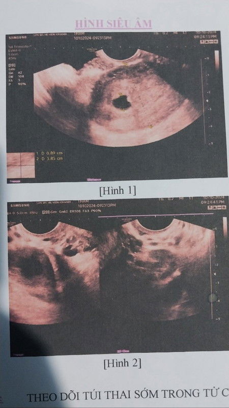 Túi thai em bị méo