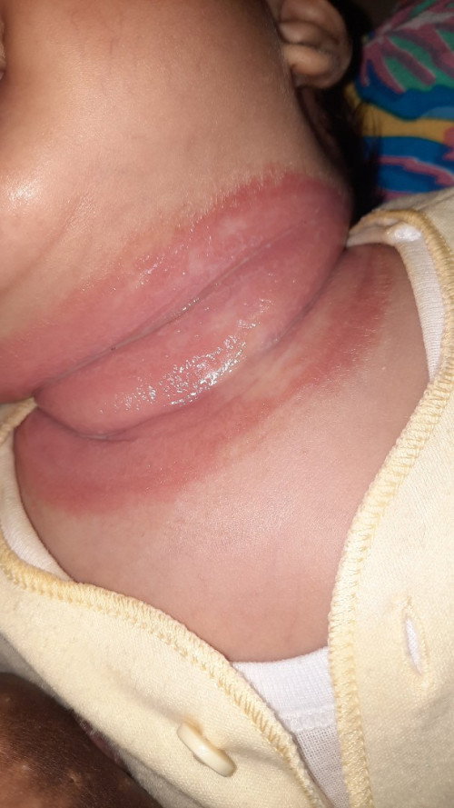 Ruam pada bayi