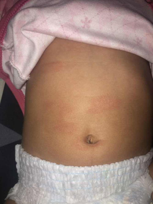 Ruam kering di perut baby