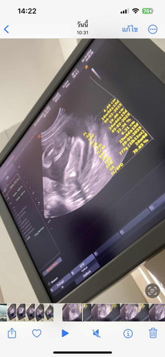 แม่ๆ ช่วยดูหน่อยค่ะอายุครรภ์ 24 สัปดาห์ แบบนี้ใช่ลูกสาว100%ไหมคะหมอบอกว่าน้องนอนท่าก้นแอบดูยาก หมอเดาว่าลูกสาวแต่ไม่แน่ใจ