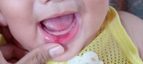 น้องปากแตก