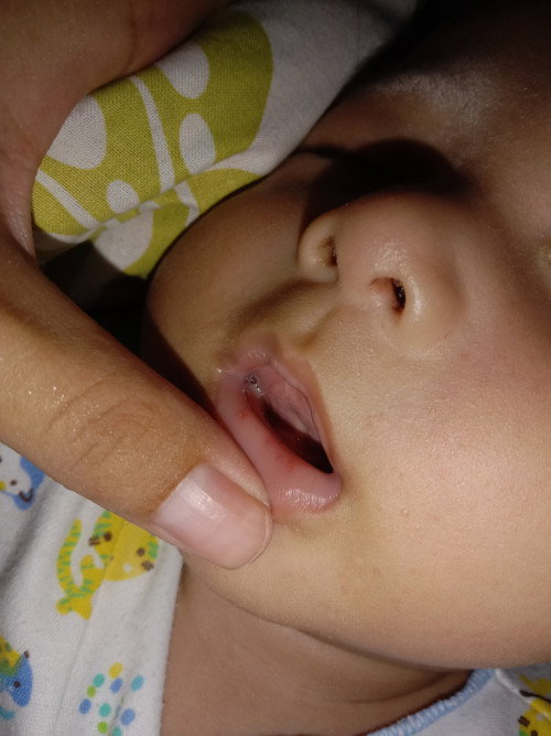 Bintik merah pada bibir bayi