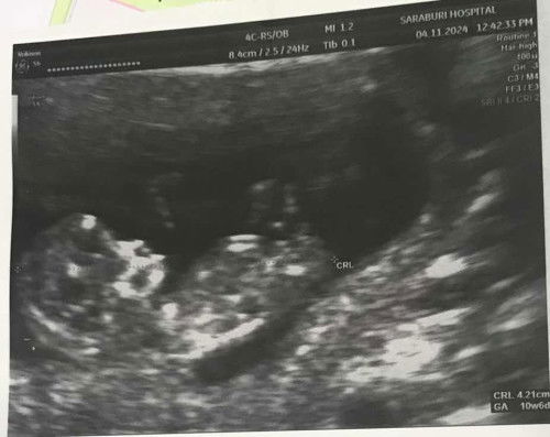 ขอดูรูปอัลตราซาวด์แม่ๆหน่อยค่ะบ้านนี้รูปซาวตอน10+6วีค ตอนนี้12+6แล้วค่ะยังไม่ได้ซาวใหม่เลย