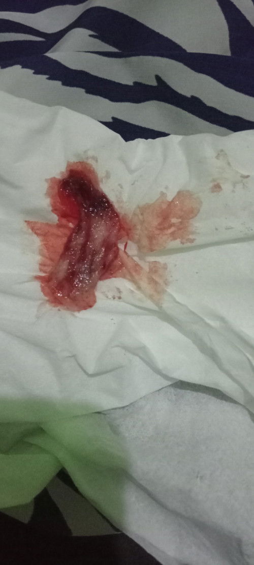 Gumpalan apa keguguran