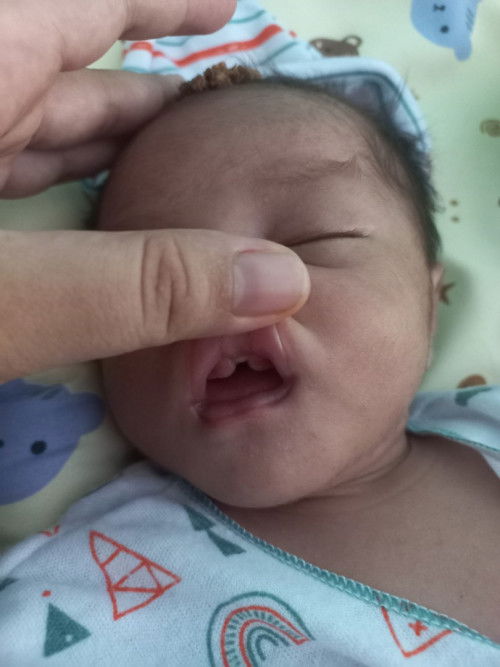 Gusi bayi baru lahir