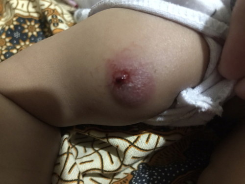 Bisul bekas suntik bcg pecah keluar nanah dan darah biar cepet sembuh gimana ya mom