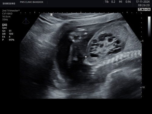 น้องมีถุงน้ำในไต