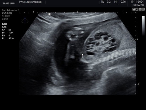 น้องมีถุงน้ำในไต