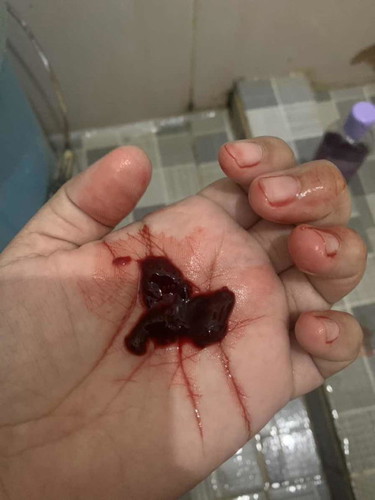 Blood clot