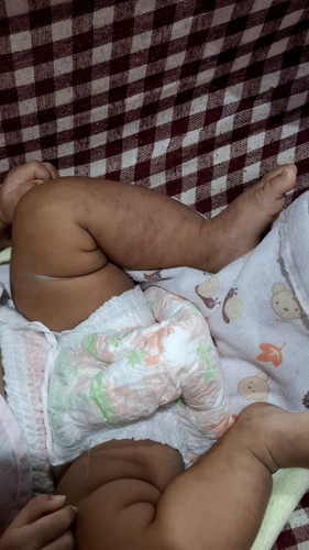 น้องฉีดวัคซีน2เดือนแล้วขึ้นแบบนี้ทำยังไงค่ะ