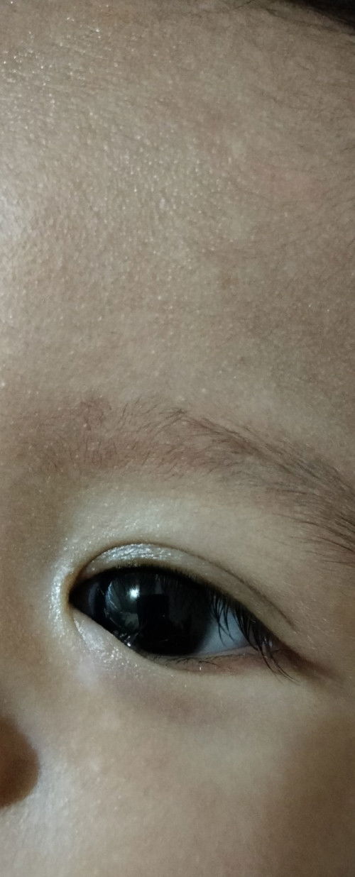 Bercak putih pada wajah bayi