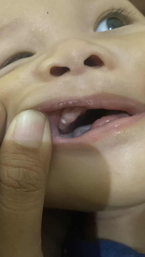 Putih putih di gusi bayi