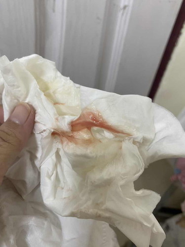 มูกเลือดแบบนี้ ใช่ใกล้คลอดไหม