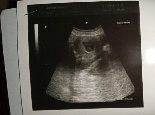 8w2d Belum ada janin, USG di puskesmas