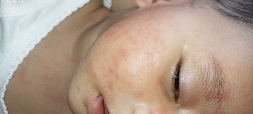 Mau tanya Bun ini anak ku kenapa ya kalo bangun tidur dia seperti ini tapi nanti hilang lagi...