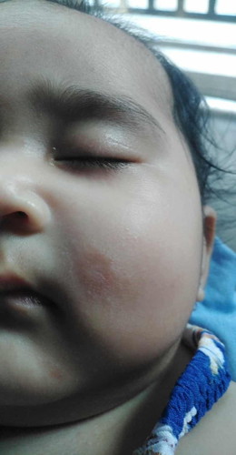 Rashes sa muka